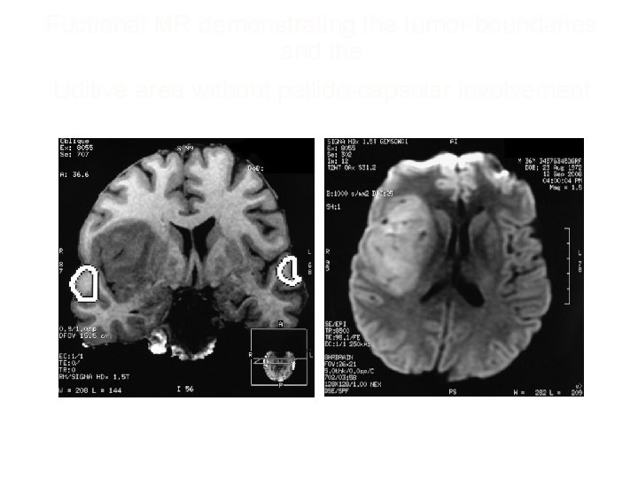 Fuctional MR demonstrating the tumor boundaries and the Uditive area without pallido-capsular involvement 