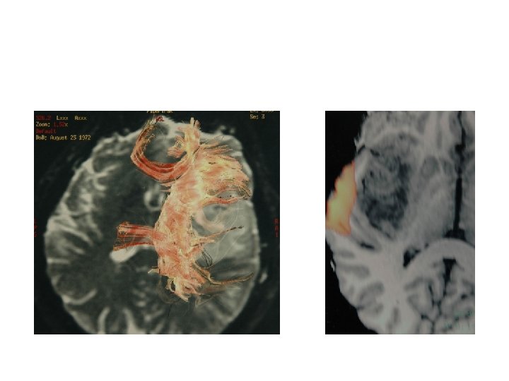 Tractography of capsula interna axial view and temporal opercular uditive area in right hemisphere
