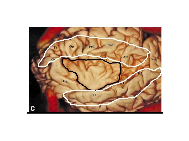 Insular anatomy After opening the temporal and fronto-parietal opercula 