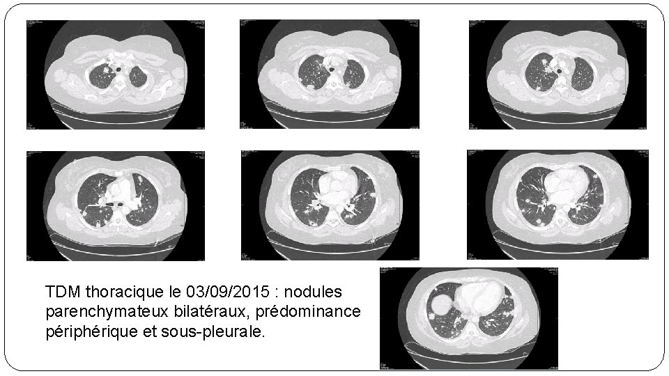 TDM thoracique le 03/09/2015 : nodules parenchymateux bilatéraux, prédominance périphérique et sous-pleurale. 
