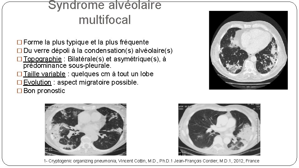 Syndrome alvéolaire multifocal � Forme la plus typique et la plus fréquente � Du