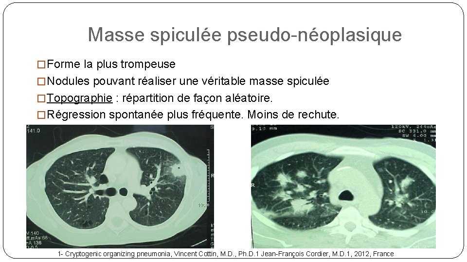 Masse spiculée pseudo-néoplasique � Forme la plus trompeuse � Nodules pouvant réaliser une véritable