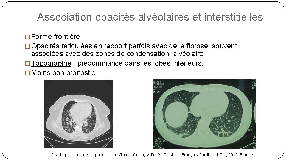 Association opacités alvéolaires et interstitielles � Forme frontière � Opacités réticulées en rapport parfois