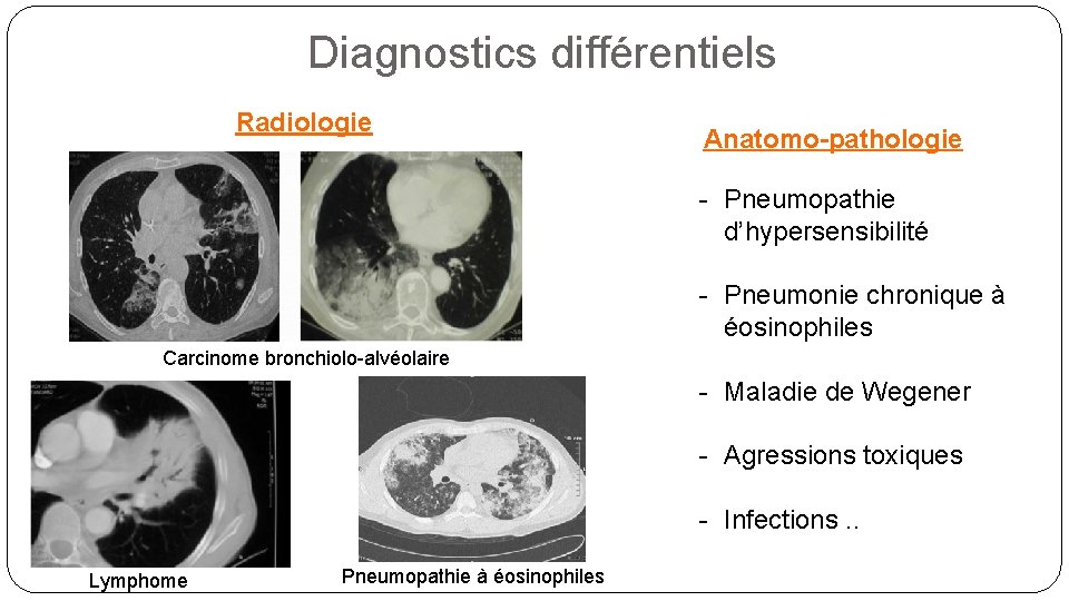 Diagnostics différentiels Radiologie Anatomo-pathologie - Pneumopathie d’hypersensibilité - Pneumonie chronique à éosinophiles Carcinome bronchiolo-alvéolaire