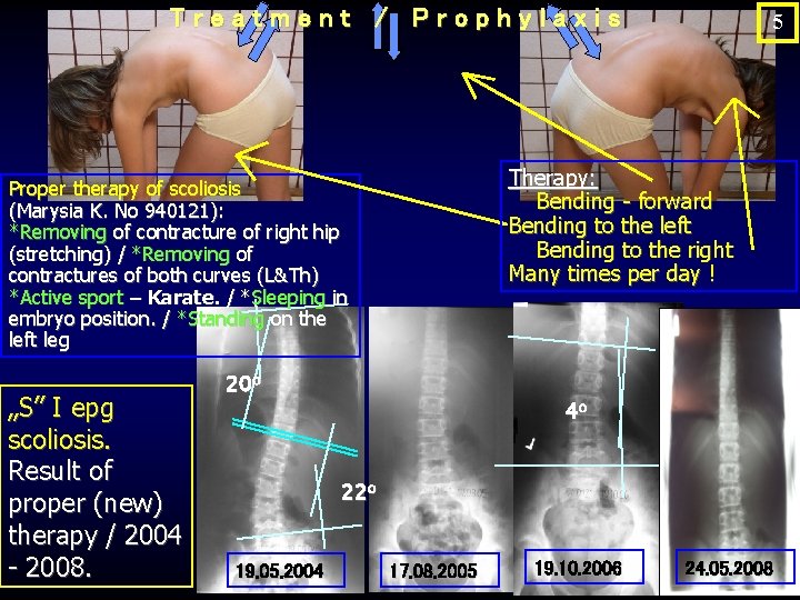 Treatment / Prophylaxis Therapy: Bending - forward Bending to the left Bending to the