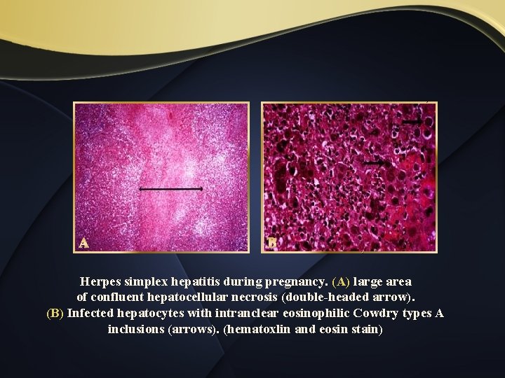A B Herpes simplex hepatitis during pregnancy. (A) large area of confluent hepatocellular necrosis