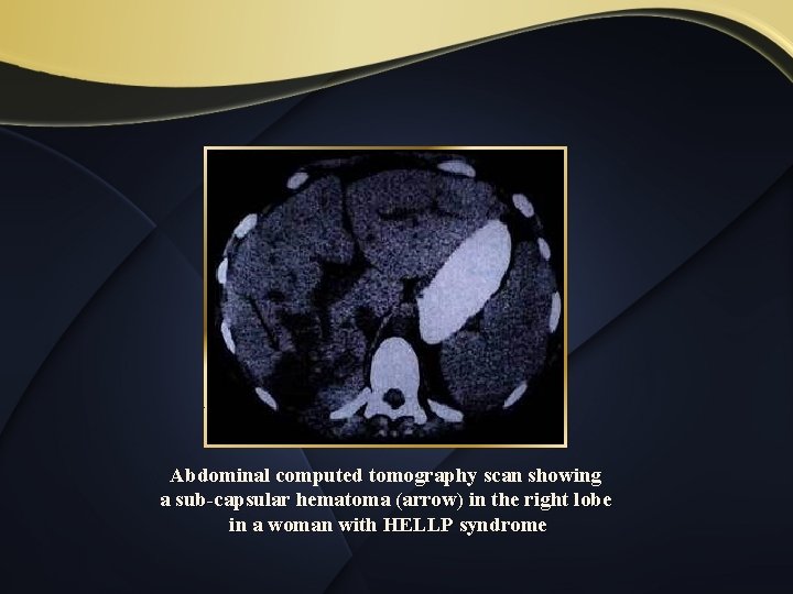 Abdominal computed tomography scan showing a sub-capsular hematoma (arrow) in the right lobe in