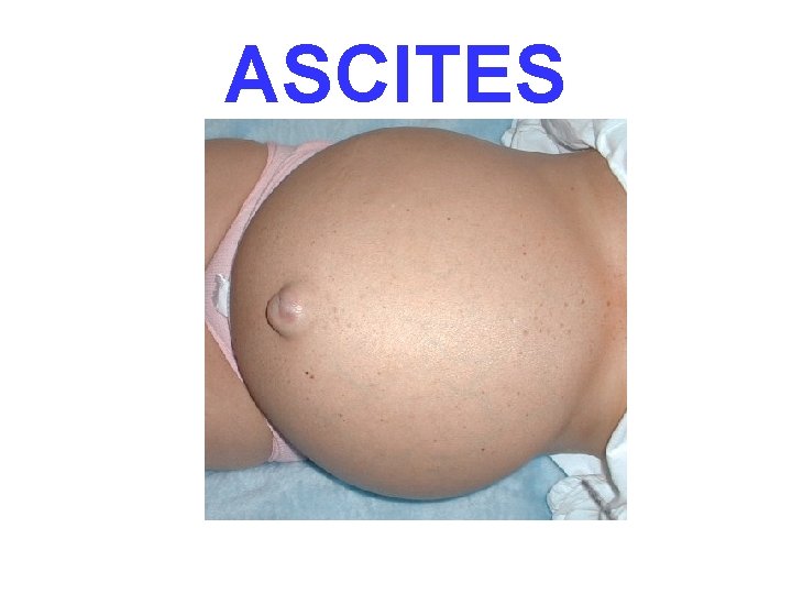 ASCITES 