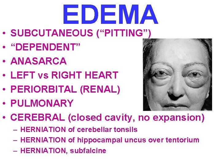  • • EDEMA SUBCUTANEOUS (“PITTING”) “DEPENDENT” ANASARCA LEFT vs RIGHT HEART PERIORBITAL (RENAL)