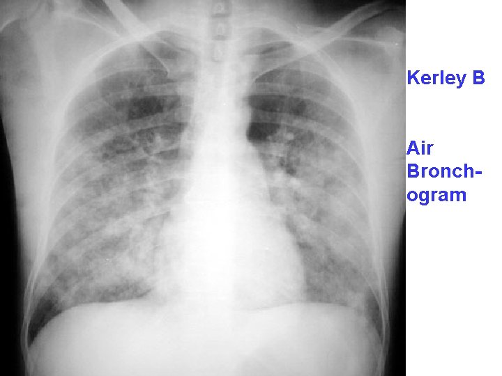 Kerley B Air Bronchogram 