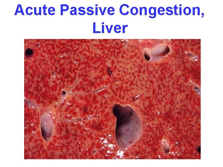 Acute Passive Congestion, Liver 