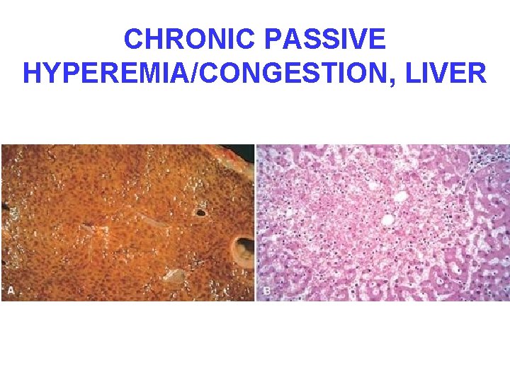 CHRONIC PASSIVE HYPEREMIA/CONGESTION, LIVER 