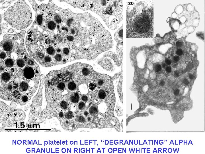 NORMAL platelet on LEFT, “DEGRANULATING” ALPHA GRANULE ON RIGHT AT OPEN WHITE ARROW 