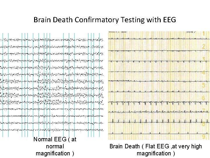 Brain Death Confirmatory Testing with EEG Normal EEG ( at normal magnification ) Brain Brain Death Confirmatory Testing with EEG Normal EEG ( at normal magnification ) Brain