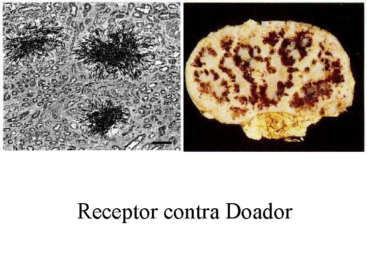 Receptor contra Doador Receptor contra Doador