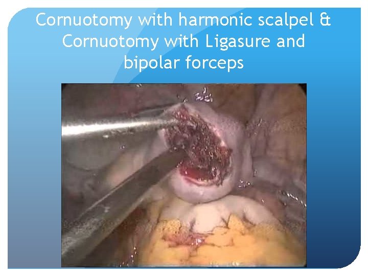 Cornuotomy with harmonic scalpel & Cornuotomy with Ligasure and bipolar forceps 