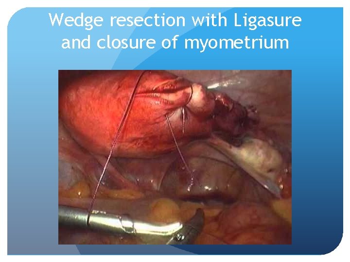 Wedge resection with Ligasure and closure of myometrium 