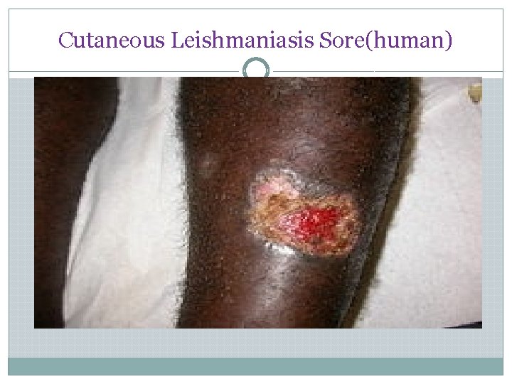Cutaneous Leishmaniasis Sore(human) 
