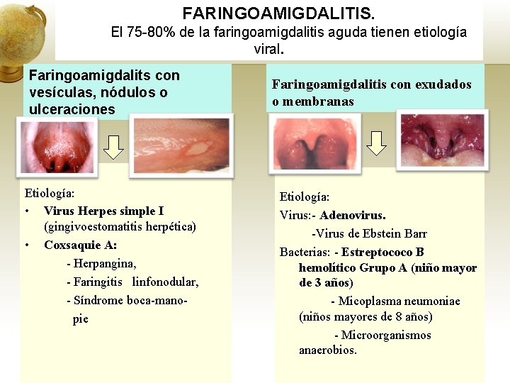 FARINGOAMIGDALITIS. El 75 -80% de la faringoamigdalitis aguda tienen etiología viral. Faringoamigdalits con vesículas,