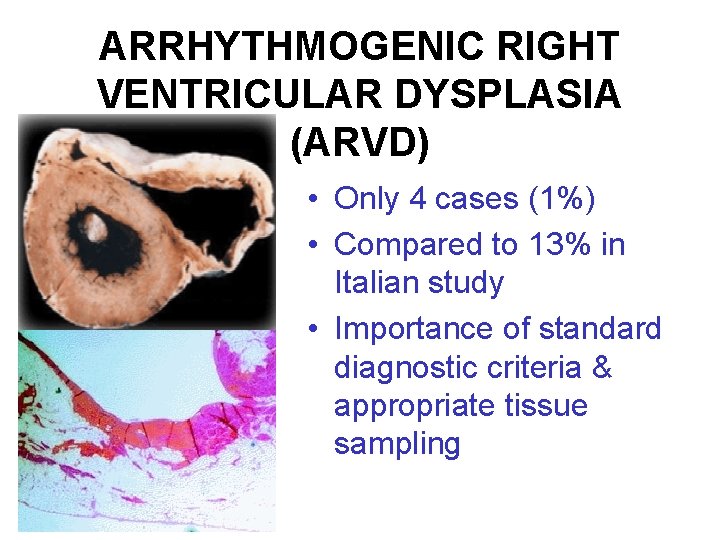 ARRHYTHMOGENIC RIGHT VENTRICULAR DYSPLASIA (ARVD) • Only 4 cases (1%) • Compared to 13%