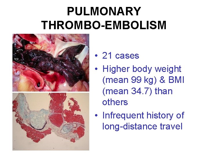 PULMONARY THROMBO-EMBOLISM • 21 cases • Higher body weight (mean 99 kg) & BMI