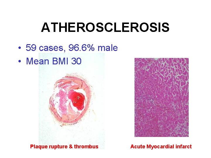 ATHEROSCLEROSIS • 59 cases, 96. 6% male • Mean BMI 30 Plaque rupture &