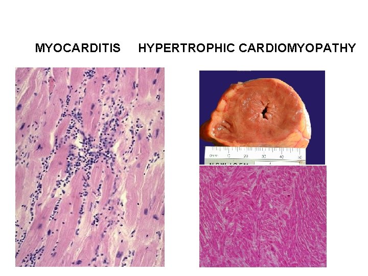 MYOCARDITIS HYPERTROPHIC CARDIOMYOPATHY 