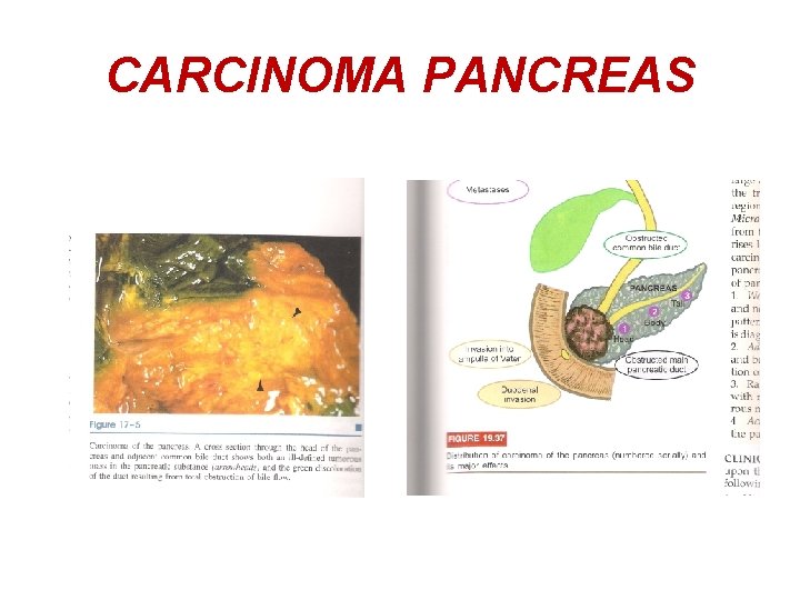 CARCINOMA PANCREAS 