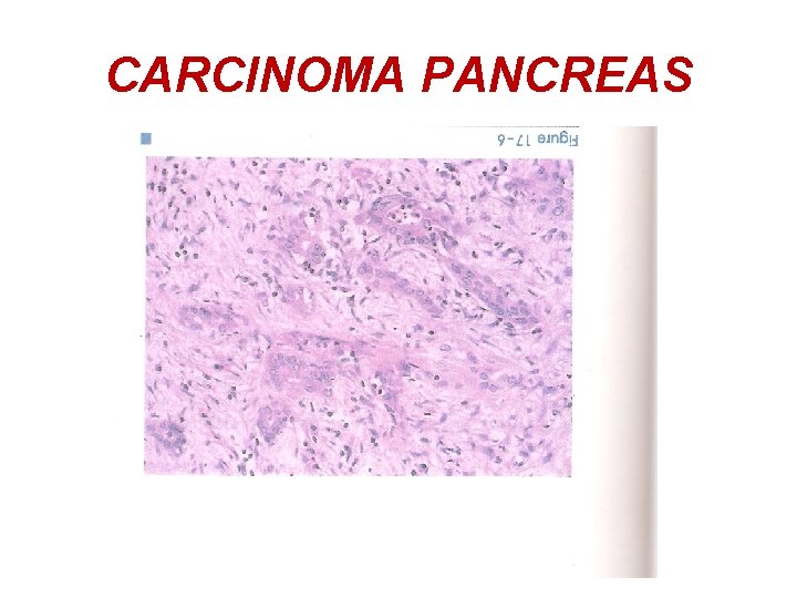 CARCINOMA PANCREAS 