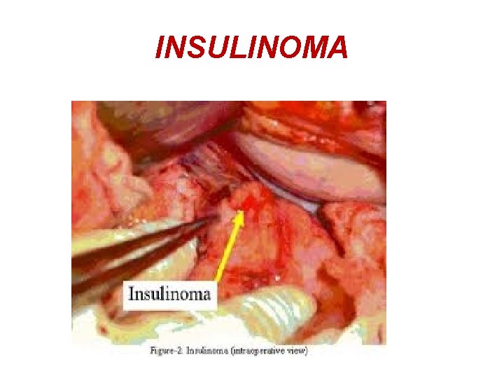 INSULINOMA 