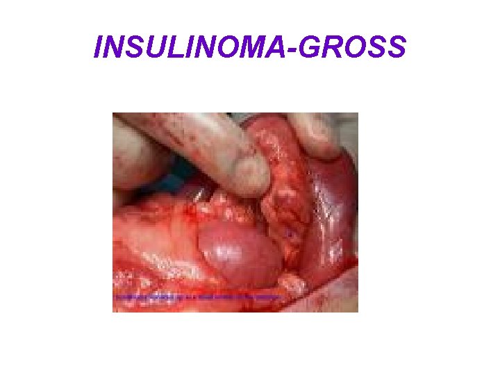 INSULINOMA-GROSS 