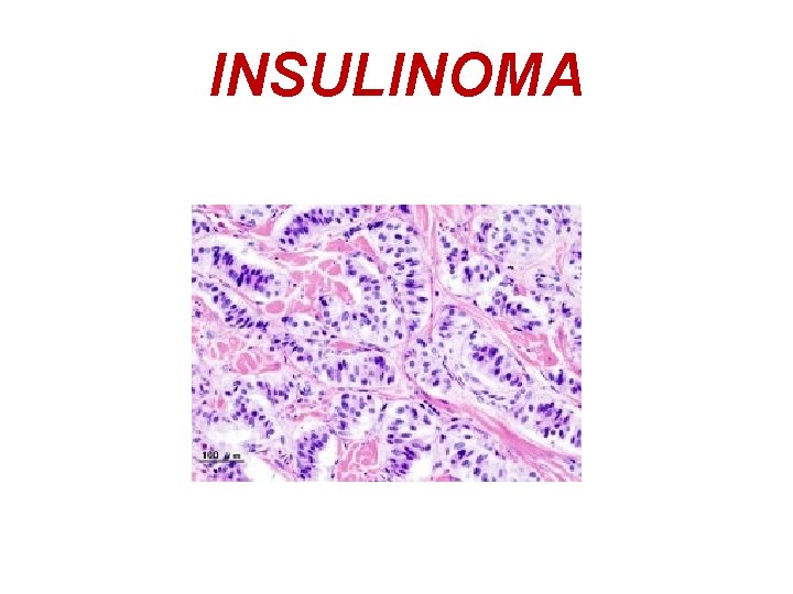 INSULINOMA 