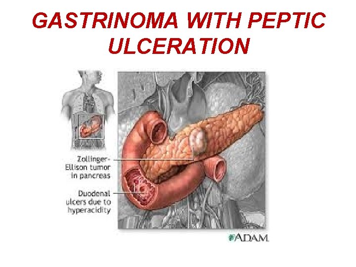 GASTRINOMA WITH PEPTIC ULCERATION 