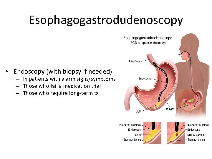 Esophagogastrodudenoscopy • Endoscopy (with biopsy if needed) – In patients with alarm signs/symptoms –