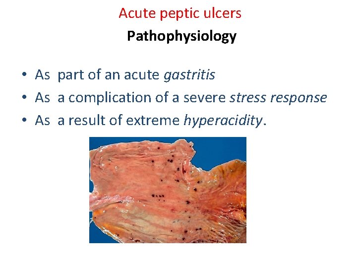 Acute peptic ulcers Pathophysiology • As part of an acute gastritis • As a