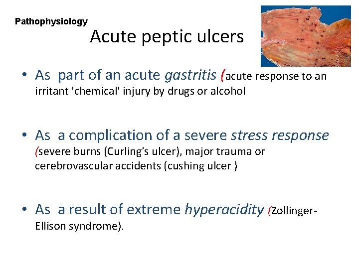 Pathophysiology Acute peptic ulcers • As part of an acute gastritis (acute response to