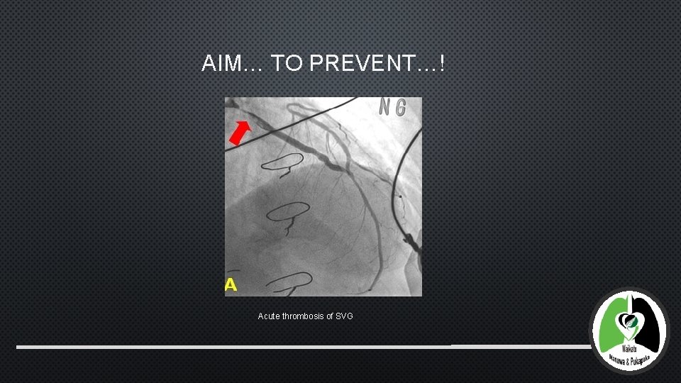 AIM… TO PREVENT…! Acute thrombosis of SVG 