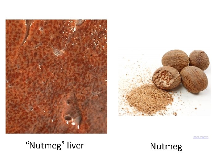 © AL G ISTOCKPHOTO/E “Nutmeg” liver Nutmeg 