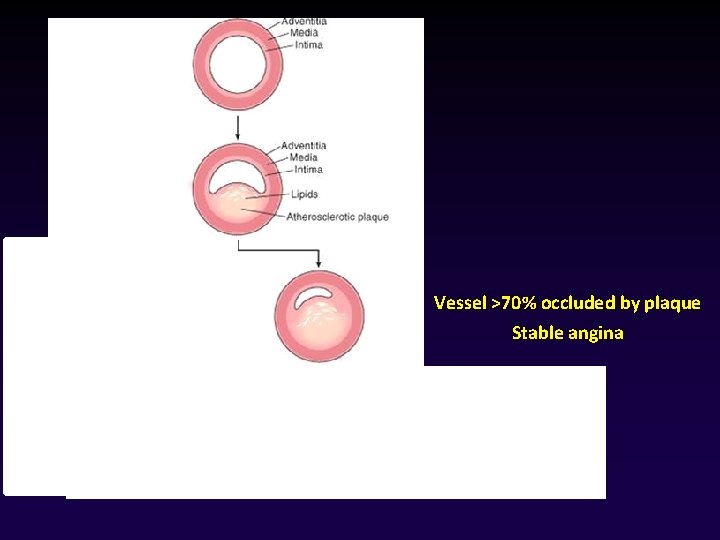 Vessel >70% occluded by plaque Stable angina 