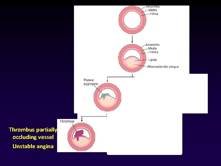 Thrombus partially occluding vessel Unstable angina 