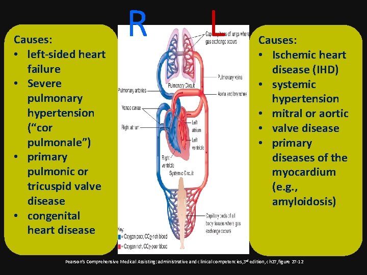 Causes: • left-sided heart failure • Severe pulmonary hypertension (“cor pulmonale”) • primary pulmonic