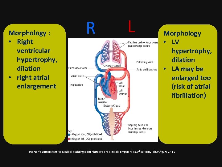 Morphology : • Right ventricular hypertrophy, dilation • right atrial enlargement R L Morphology