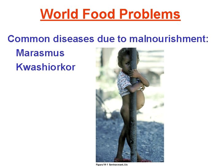 World Food Problems Common diseases due to malnourishment: Marasmus Kwashiorkor 