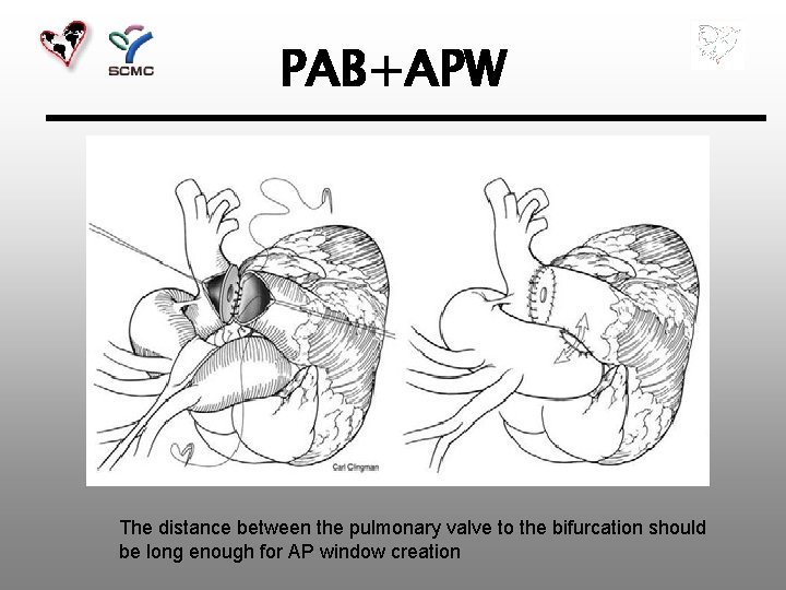 PAB+APW The distance between the pulmonary valve to the bifurcation should be long enough