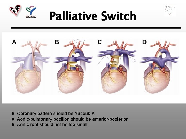 Palliative Switch l Coronary pattern should be Yacoub A l Aortic-pulmonary position should be