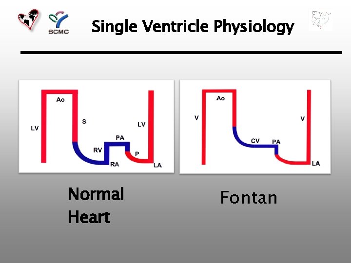 Single Ventricle Physiology Normal Heart Fontan 