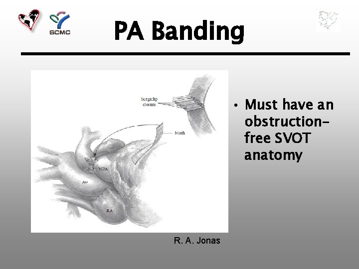 PA Banding • Must have an obstructionfree SVOT anatomy R. A. Jonas 