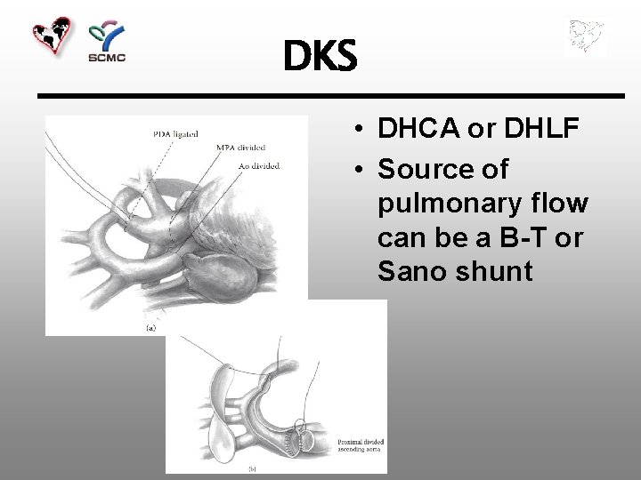 DKS • DHCA or DHLF • Source of pulmonary flow can be a B-T