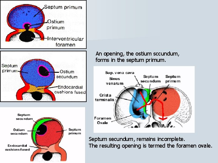 An opening, the ostium sccundum, forms in the septum primum. Septum secundum, remains incomplete.