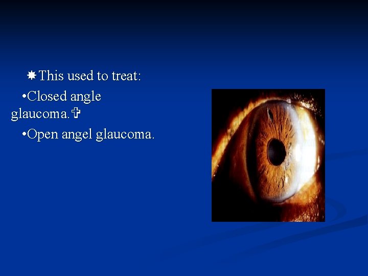  This used to treat: • Closed angle glaucoma. • Open angel glaucoma. 